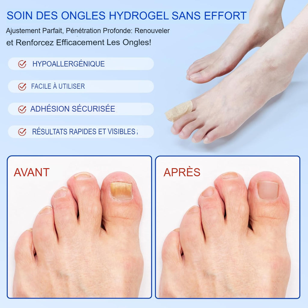 ProtectOngle Pro™ | Répare vos ongles pendant votre sommeil !