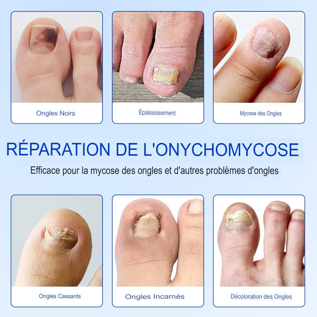 ProtectOngle Pro™ | Répare vos ongles pendant votre sommeil !
