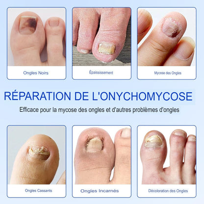 ProtectOngle Pro™ | Répare vos ongles pendant votre sommeil !