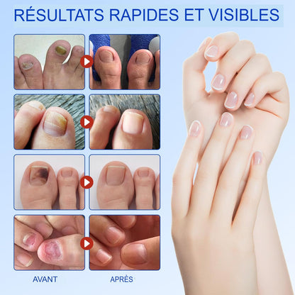 ProtectOngle Pro™ | Répare vos ongles pendant votre sommeil !